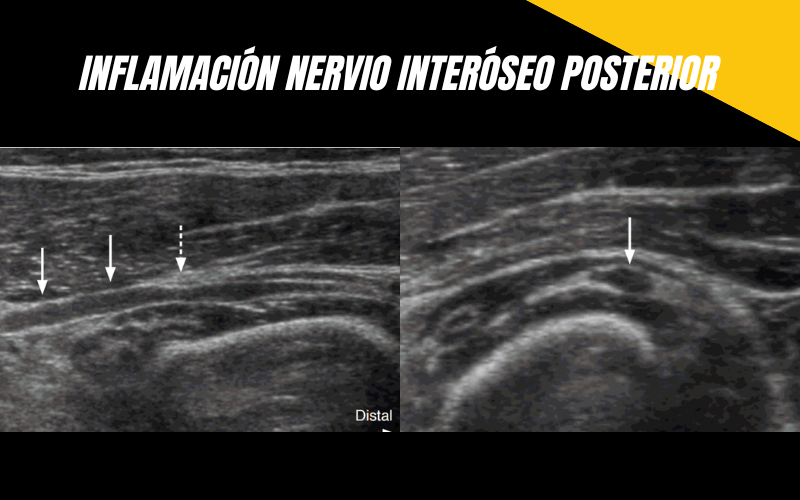 1. Nervio Interoeo Posterior Ecografia Tempo Formacion.png